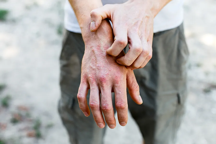 Close-up of a man scratching his hands while experiencing Psoriasis. Get care for Psoriasis from Morgan Burns, APRN in Central Florida.