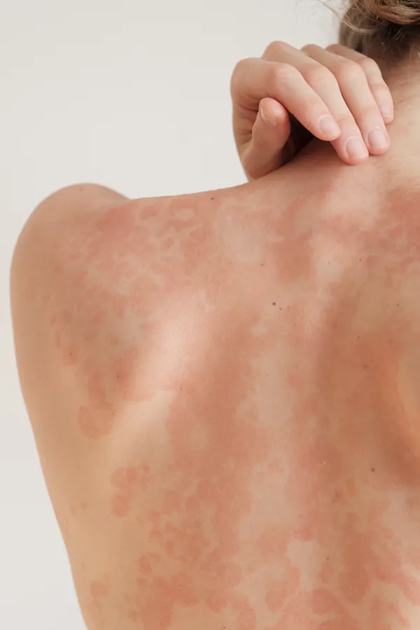 The back and shoulder of a woman experiencing Psoriasis. Get treatment for Psoriasis from Morgan Burns, APRN in Central Florida.