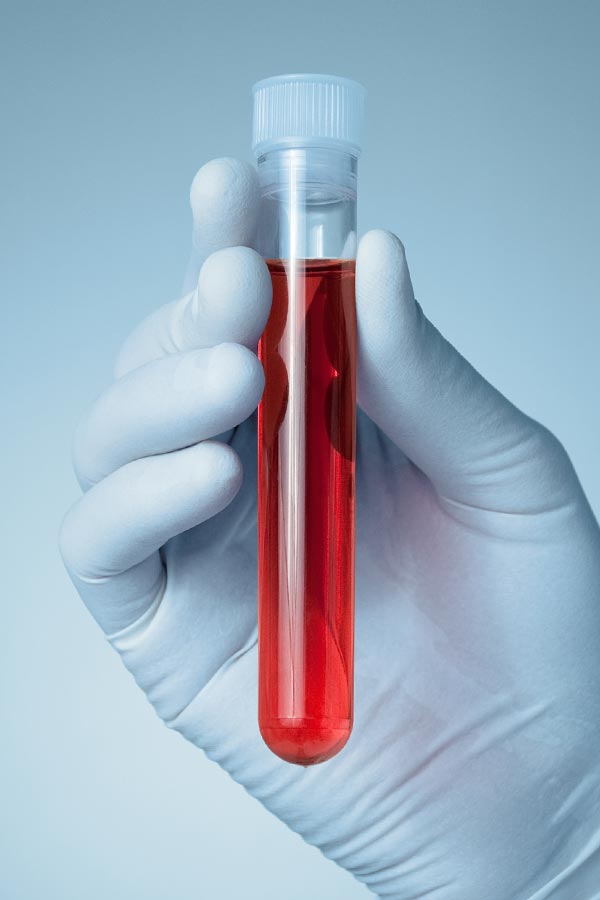Close up of a gloved hand holding a vial of red liquid, representing Frank Lanzisera, D.C.'s comprehensive autoimmune disorder treatment in Tampa Bay Metro.