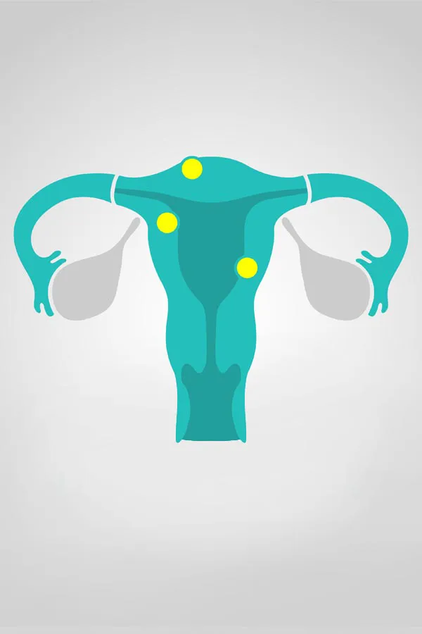 Illustration of a uterus with yellow dots indicating fibroids. Get treatment for fibroids from Frank Lanzisera, D.C. in Tampa Bay Metro.