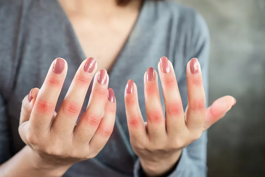 Close-up of the hands of a woman in a gray shirt, with swollen, red knuckles. Get treatment for Lupus from Frank Lanzisera, D.C. in Tampa Bay Metro.