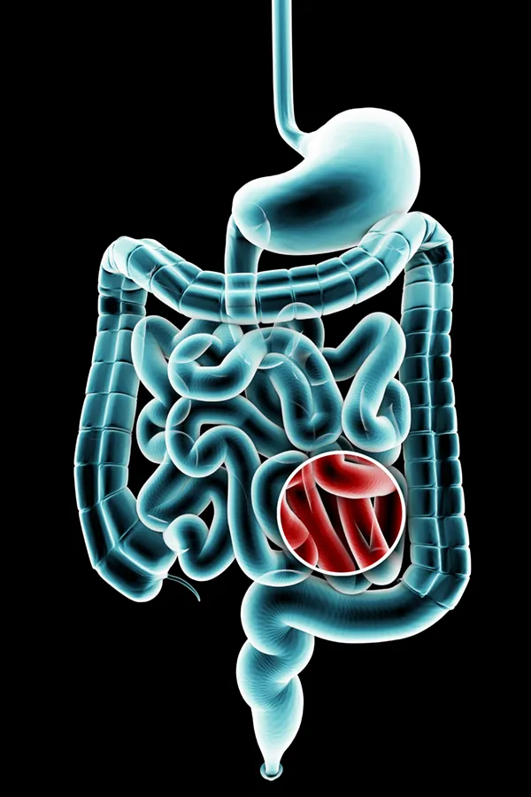 3D illustration of the digestive system in blue tones, with an area of discomfort in red tones. Get treatment for Ulcerative Colitis from Frank Lanzisera, D.C. in Tampa Bay Metro.